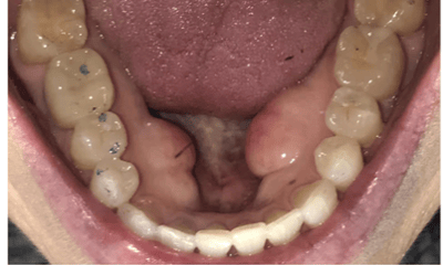 After treatment - Invisalign