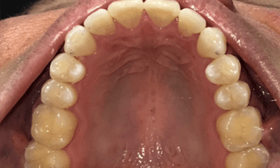 After treatment - Invisalign