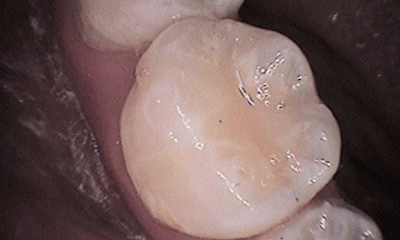After treatment - Lower Tooth Composite Fillings