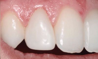 After treatment - Peg Lateral Restoration