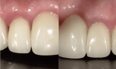 After treatment - Smile Makeover Crown