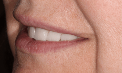 After treatment - Smile Transformation 