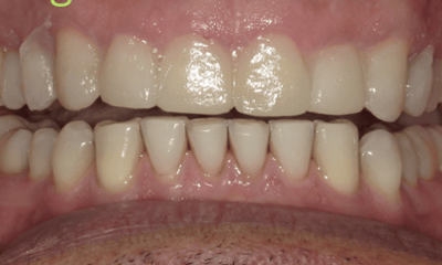 After treatment - Trial Smile Makeover
