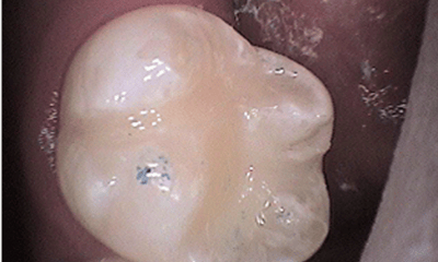 After treatment - Upper Tooth Composite Fillings