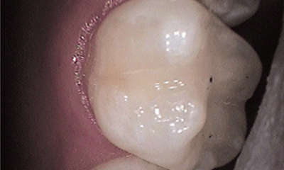 After treatment - Upper Tooth Composite Fillings