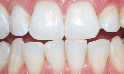 After treatment - Whitening