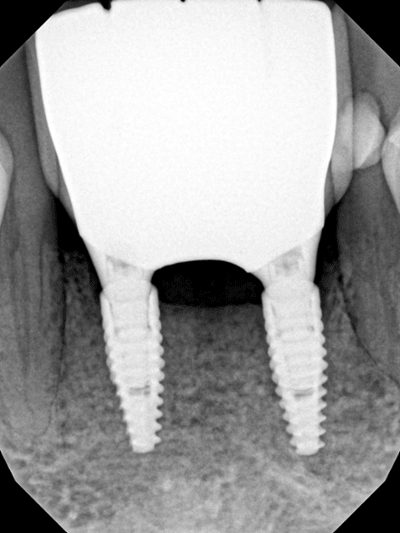 Digital x-ray: implants & bridge
