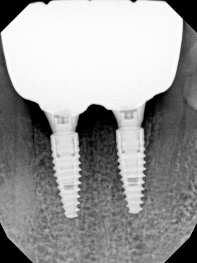 After treatment - Implant Bridge