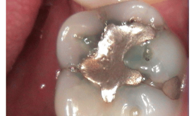 Before treatment - Amalgam Removal