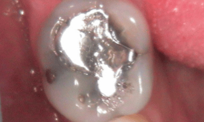 Before treatment - Amalgam Removal 