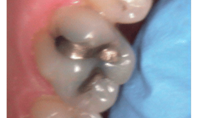Before treatment - Amalgam Removal