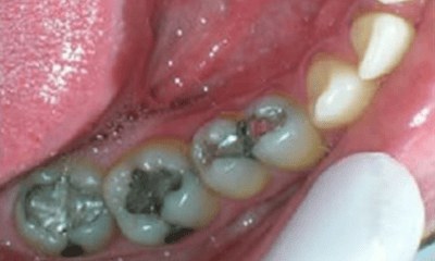 Before treatment - Amalgam Removal