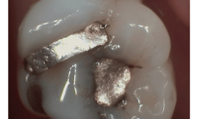 Before treatment - Amalgam Removal