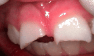 Before treatment - Anterior Bonding
