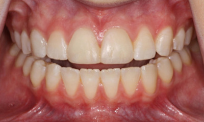Before treatment - Anterior Crown Restoration