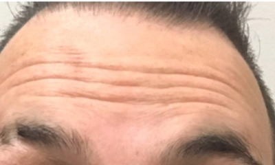 botox treatment- before photo