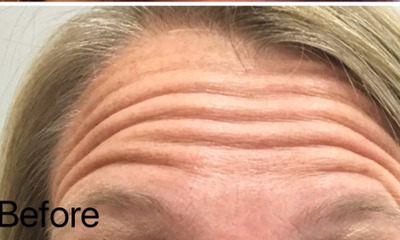 botox treatment- before photo