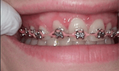 Before treatment - Veneers