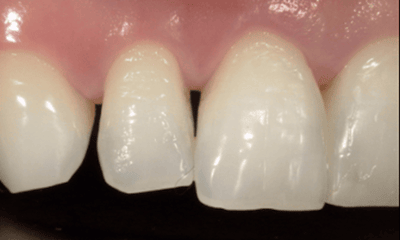 Before treatment - Veneers