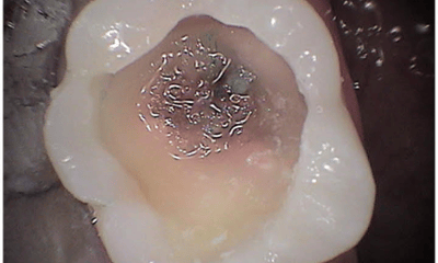 Before treatment - Composite Tooth Filling