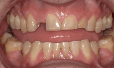 Before treatment - Crown & Bridge