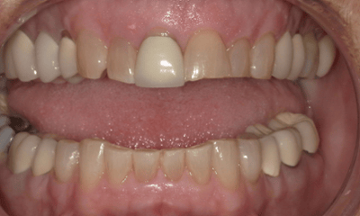 Before treatment - Crown and Bonding