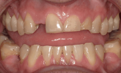Before treatment - Crown and Bridge