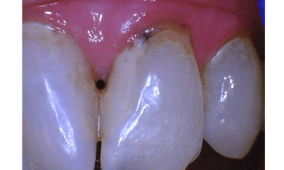 Before treatment - Crowns