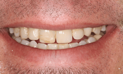 Before treatment - Crowns