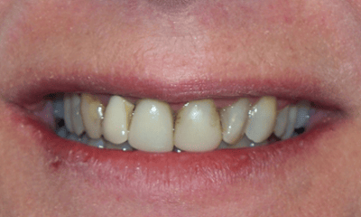 Before treatment - Crowns