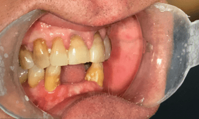 Before treatment - Lower Implant Bridge