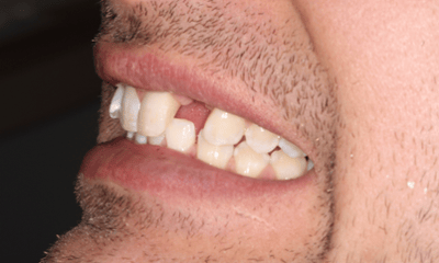 Before treatment - Dental Implants