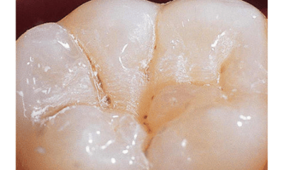 Before treatment - Dental Sealants