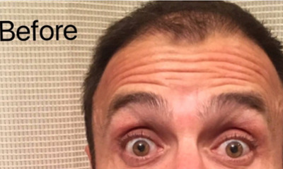 botox treatment- before photo