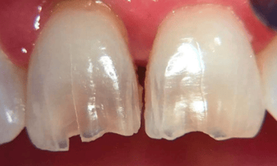 Before treatment - Front Teeth Bonding