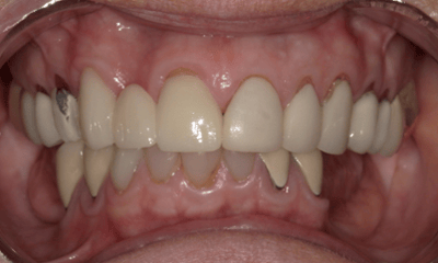 Before treatment - Upper Crowns & Bridges with Lower Implant Hybrid Bridge 
