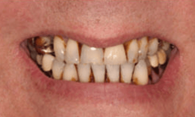 Before treatment - Hybrid Dental Implants