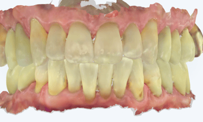 Before treatment - Implant Bridge