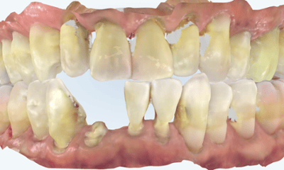 Before treatment - Implant Bridge