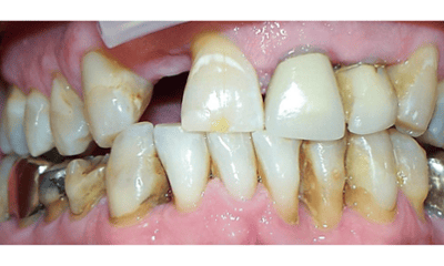 Before treatment - Crowns & Implant 