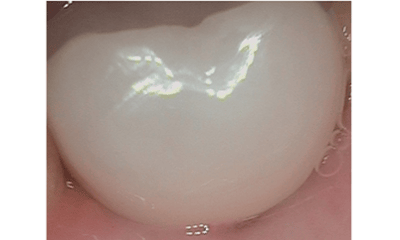 Before treatment - Implant Natural Look