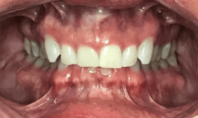 Before treatment - Invisaligh and Gum Recontouring