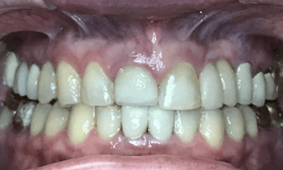 Before treatment - Invisalign & Crown
