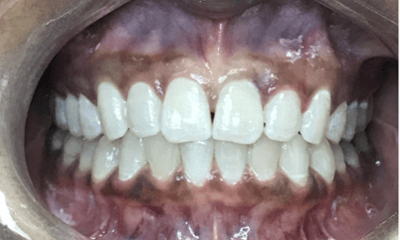 Before treatment - Invisalign Black Triangle