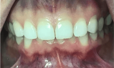 Before treatment - Invisalign Crowding & Single Tooth Crossbite