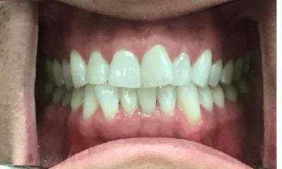 Before treatment - Invisalign Crowding