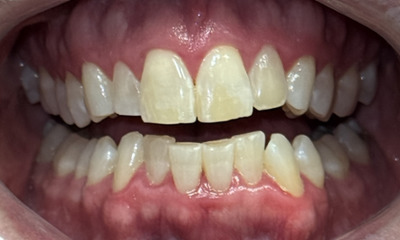 Before treatment - Invisalign & Bonding
