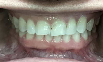 Before treatment - Invisalign & Crowns Combo