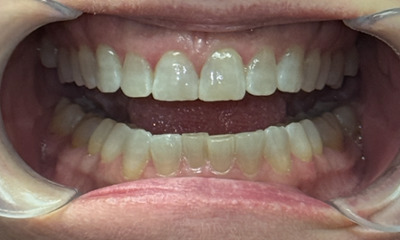 Before treatment - Invisalign-relapse