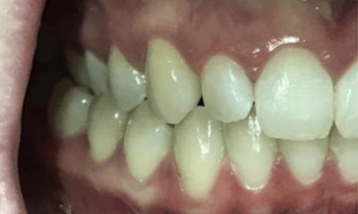 Before treatment - Invisalign Rotation Crossbite